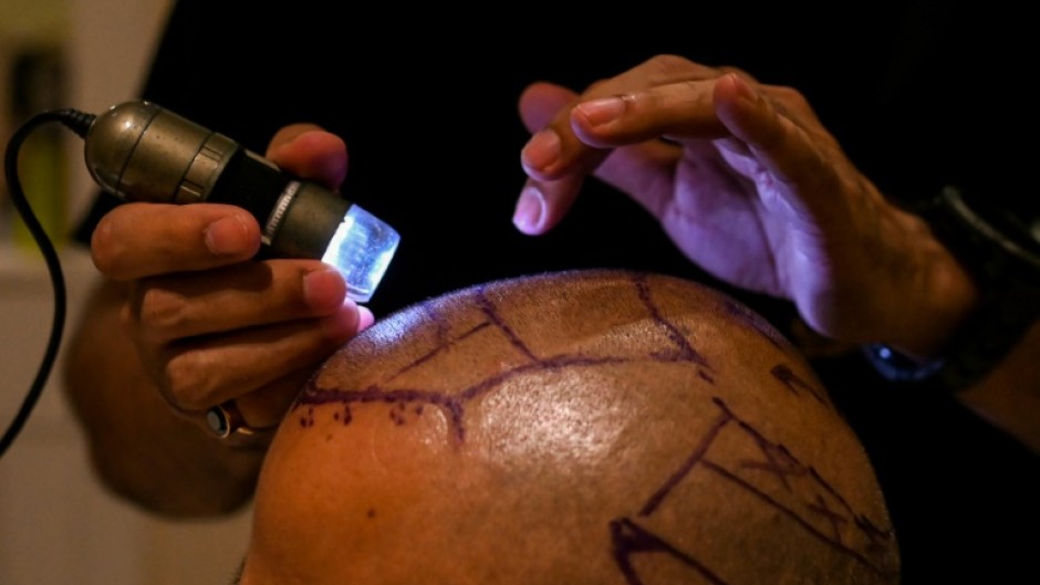 Dr. Mayank Singh inspects the scalp of a patient before a hair transplant at the Crown clinic in New Delhi