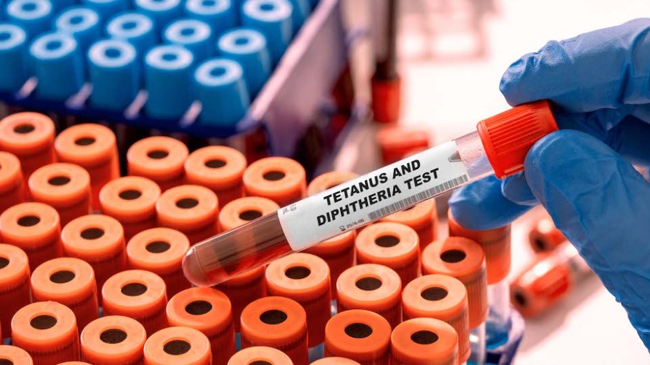 File: A tetanus and diphtheria blood test. AFP/Wladimir Bulgar/WBU/Science Photo Library via AFP