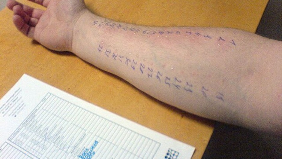 File: Allergy skin testing. Wikimedia Commons/Wolfgang Ihloff
