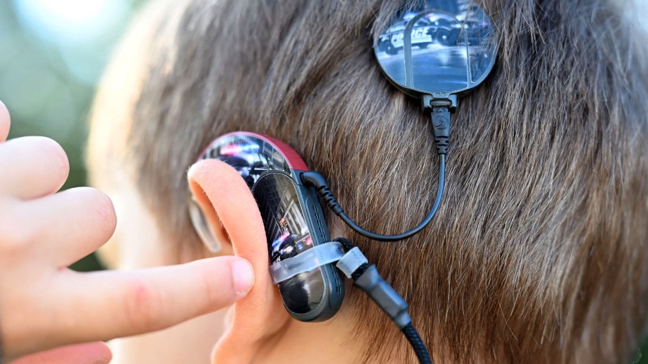 A cochlear implant, a hearing prosthesis, is attached to the back of a boy's head. Uli Deck/dpa Picture-Alliance via AFP