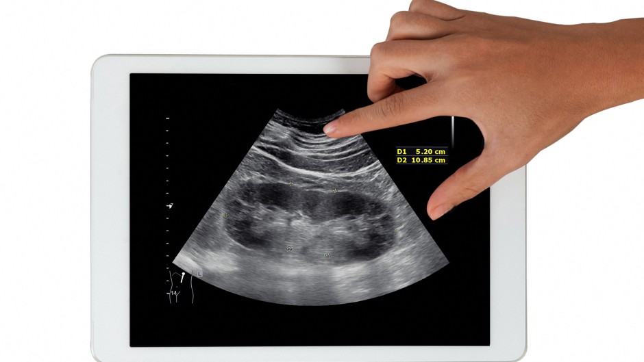 Conceptual image of a kidney disease diagnosis. SAMUNELLA/Science Photo Library via AFP