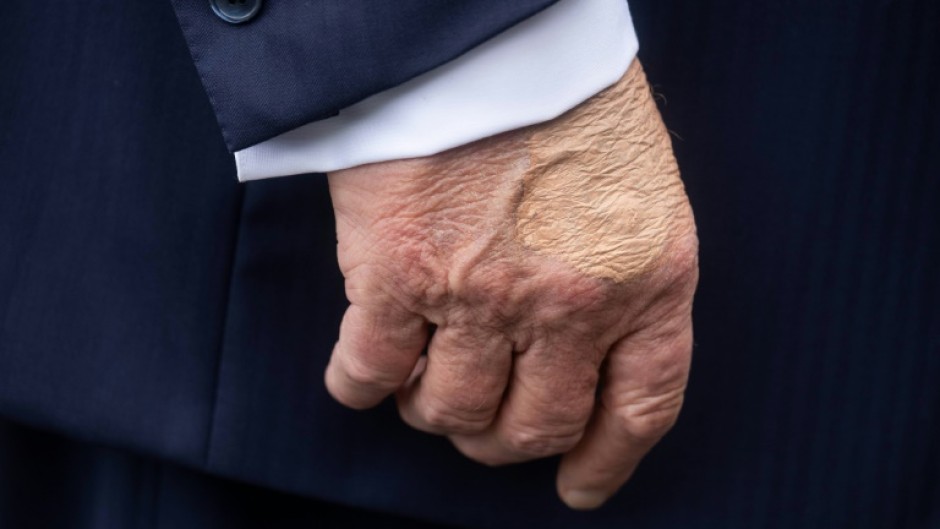 US President Donald Trump's right hand is bruised due to shaking hands and taking aspirin, the White House says