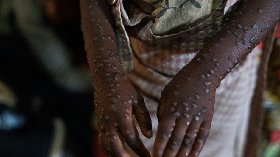 Mpox causes large boil-like skin lesions