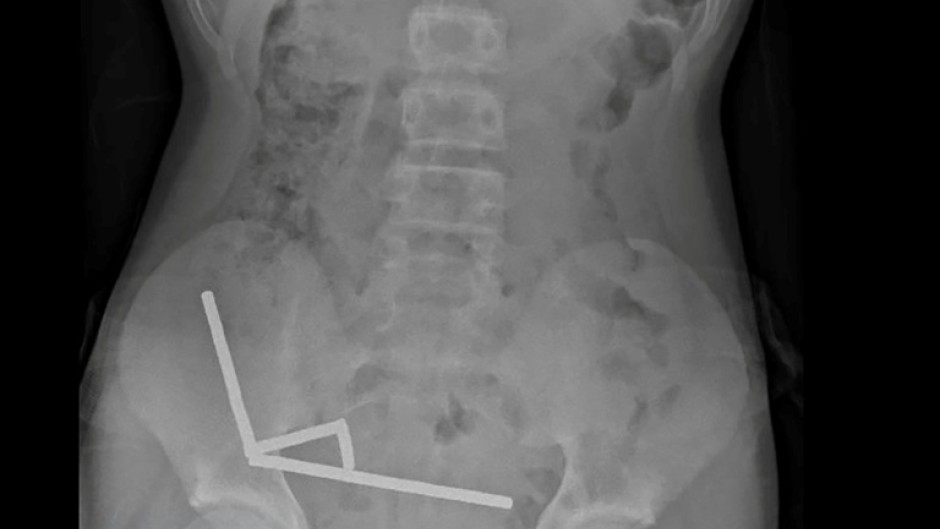 This undated handout released on October 24, 2025 from the New Zealand Medical Journal (NZMJ) shows an x-ray image of pieces of high-power magnets clumped up in the intestines of a New Zealand teenager in Tauranga