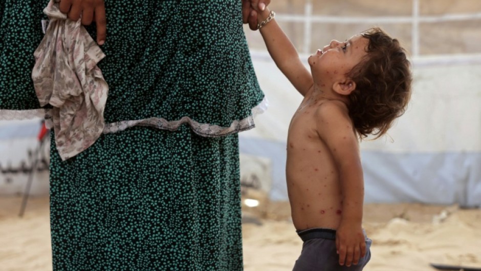 UNICEF said health officials had already recorded more than 9,300 suspected cases of chickenpox across Gaza in early July