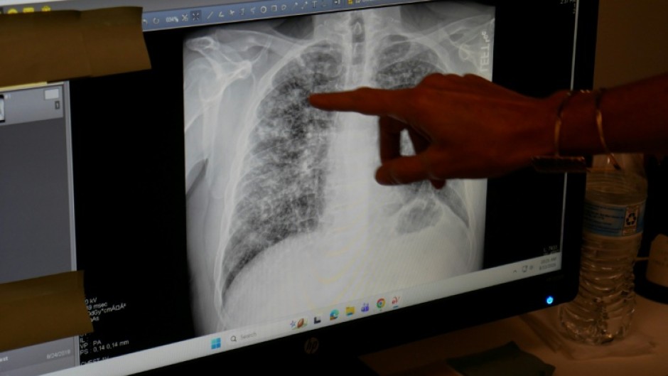 Lisa Emery, director of the Breathing Center and Black Lung Clinic at New River Health, shows an X-ray of the lungs of a miner suffering from black lung disease