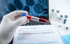 File: Blood collection for Mpox with a positive test result. GettyImages/Jun Li
