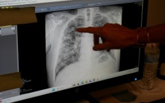 Lisa Emery, director of the Breathing Center and Black Lung Clinic at New River Health, shows an X-ray of the lungs of a miner suffering from black lung disease