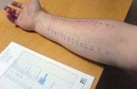 File: Allergy skin testing. Wikimedia Commons/Wolfgang Ihloff
