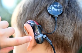 A cochlear implant, a hearing prosthesis, is attached to the back of a boy's head. Uli Deck/dpa Picture-Alliance via AFP