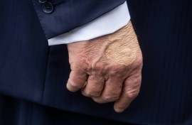 US President Donald Trump's right hand is bruised due to shaking hands and taking aspirin, the White House says