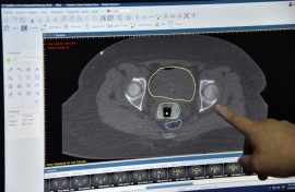 A doctor points at a screen with the tests of a patient suffering from cervical cancer