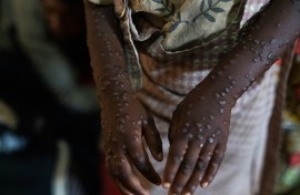 Mpox causes large boil-like skin lesions