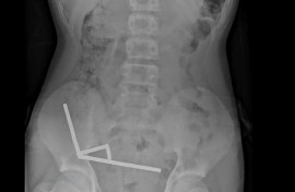 This undated handout released on October 24, 2025 from the New Zealand Medical Journal (NZMJ) shows an x-ray image of pieces of high-power magnets clumped up in the intestines of a New Zealand teenager in Tauranga