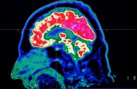 A picture of a human brain taken by PET scan