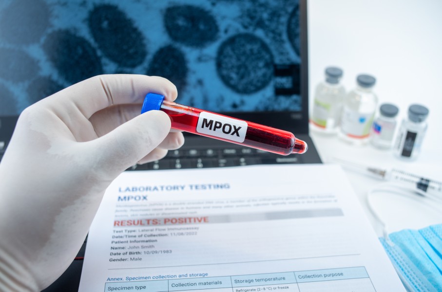 File: Blood collection for Mpox with a positive test result. GettyImages/Jun Li