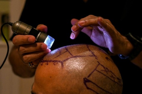 Dr. Mayank Singh inspects the scalp of a patient before a hair transplant at the Crown clinic in New Delhi