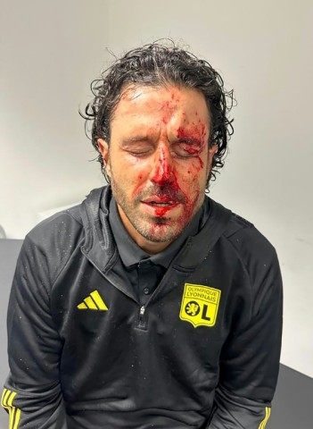 Lyon coach Fabio Grosso's face was left bloodied after a window of the team bus was smashed by stones thrown by Marseille supporters