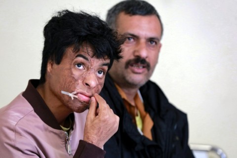 Mohammed Zakaria, 16, had dreamt of becoming a professional footballer before an air strike in his native Yemen left him with extensive burns.