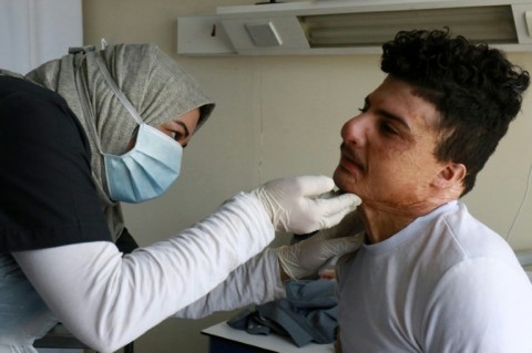 Hossam Abd al-Rahman, 21, is waiting for his ninth operation at the hospital to treat third-degree burns to his face, neck, abdomen, back and hand. He had already undergone 17 surgeries in his native Iraq.
