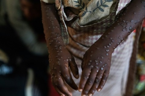 Mpox causes large boil-like skin lesions