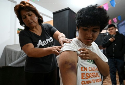 Peruvian student Angelo Nael Genti, 19, injured in the October 15 Gen Z movement protests, shows injuries during an interview with AFP