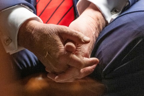 US President Donald Trump blames aspirin for bruises on his hand