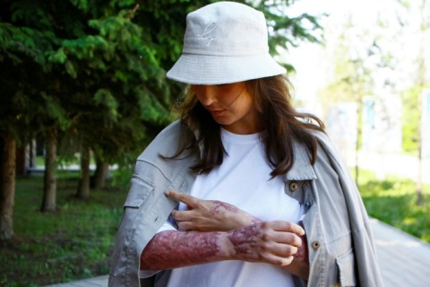 Zarina Giyassova suffered burns to 65 percent of her body in a gas cylinder blast