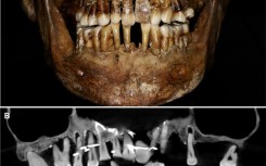 The teeth of 17th century French aristocrat Anne d'Alegre, with a gold wire threading through several