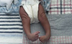 Clubfoot Treatment