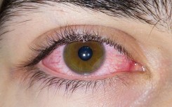 File: Viral conjunctivitis or pink eye. Wikimedia Commons/Hızır Erdem Uygun