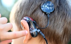 A cochlear implant, a hearing prosthesis, is attached to the back of a boy's head. Uli Deck/dpa Picture-Alliance via AFP