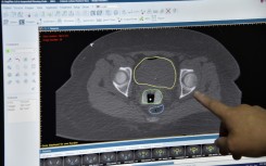 A doctor points at a screen with the tests of a patient suffering from cervical cancer