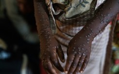 Mpox causes large boil-like skin lesions