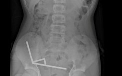This undated handout released on October 24, 2025 from the New Zealand Medical Journal (NZMJ) shows an x-ray image of pieces of high-power magnets clumped up in the intestines of a New Zealand teenager in Tauranga