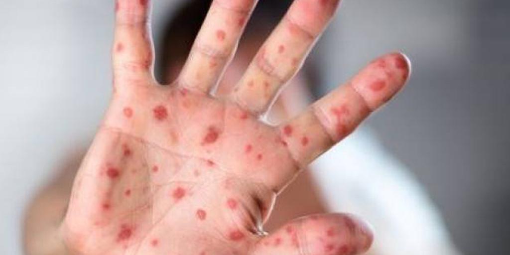 Measles outbreak spreads to 5 provinces: NICD - Vimarsana News